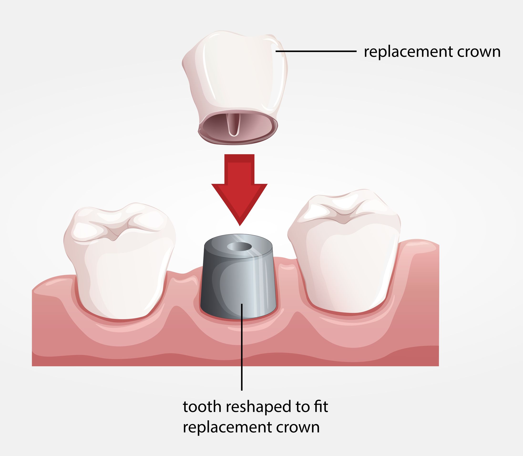 Future of Dental Implants